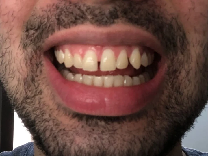 Dientes separados con espacios entre los incisivos antes del tratamiento con alineadores moons